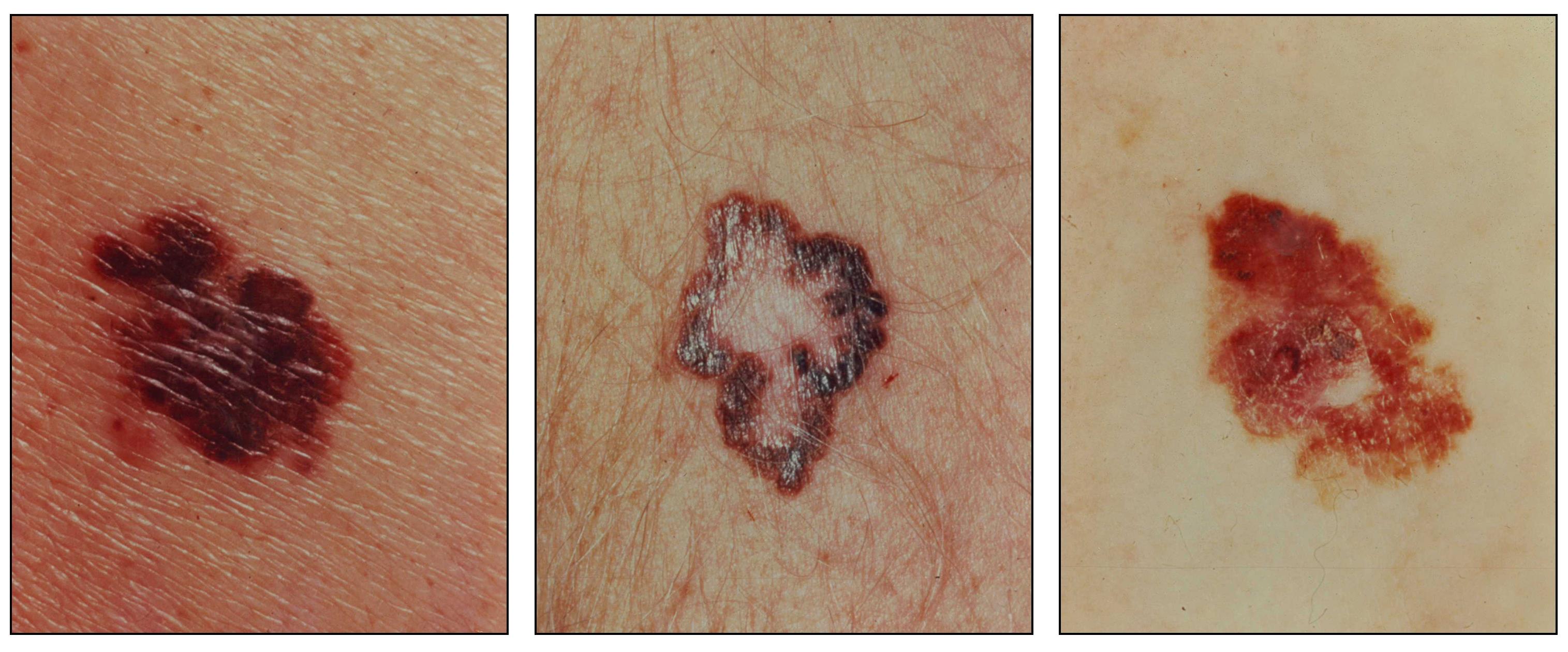 What Does Melanoma Look Like New Health Advisor 1831